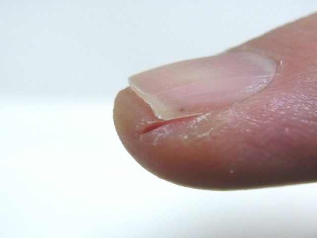 指先のあかぎれ